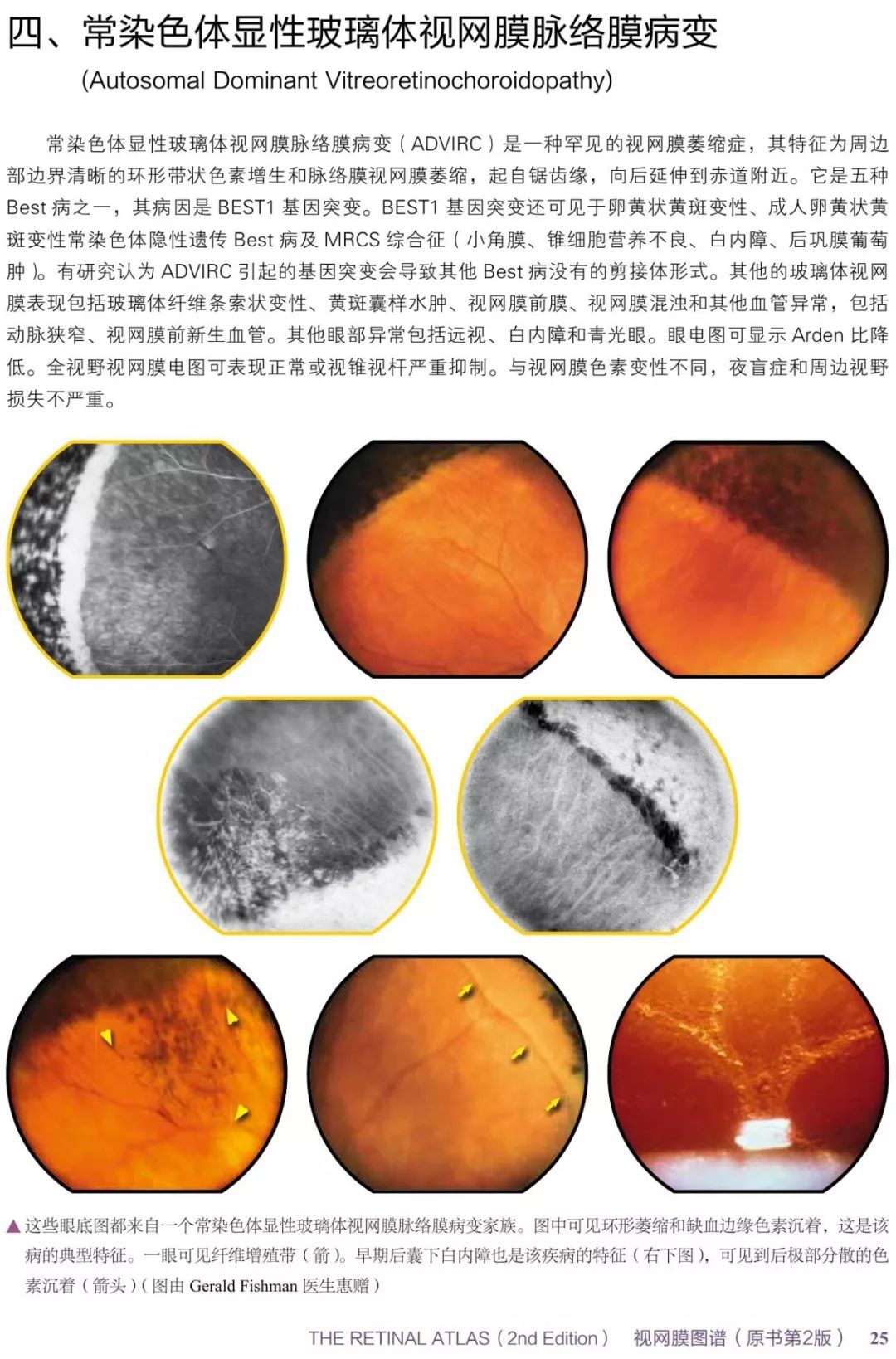 眼底病变眼睛图片,眼底病变的高清挂图