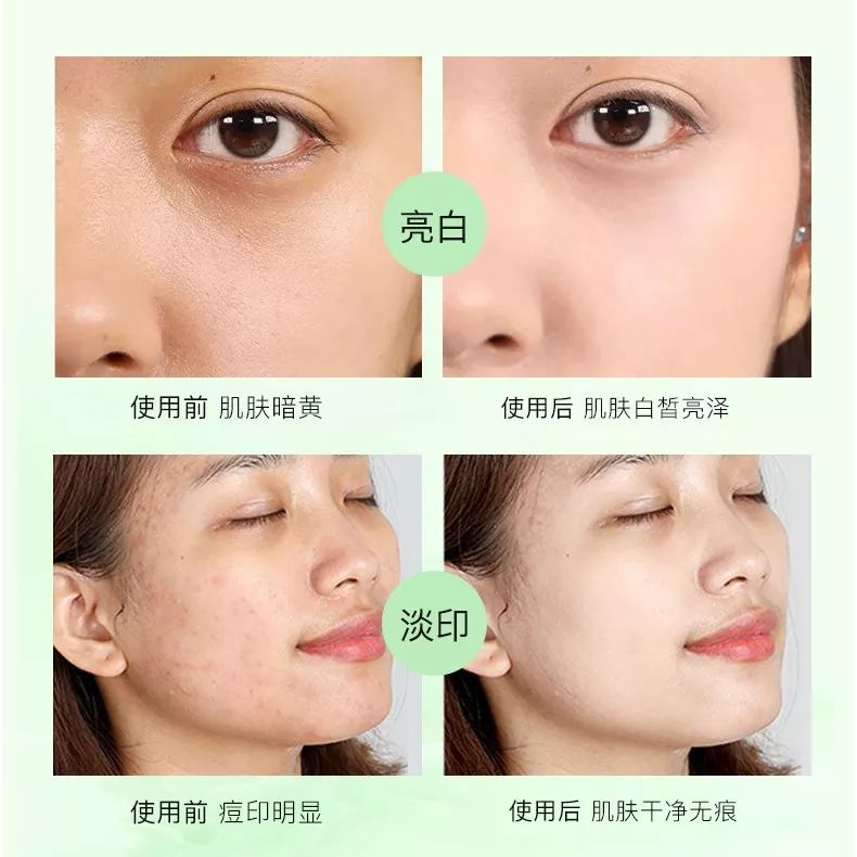 脸上螨虫黑头用完除螨皂好了,脸上有螨虫防螨皂