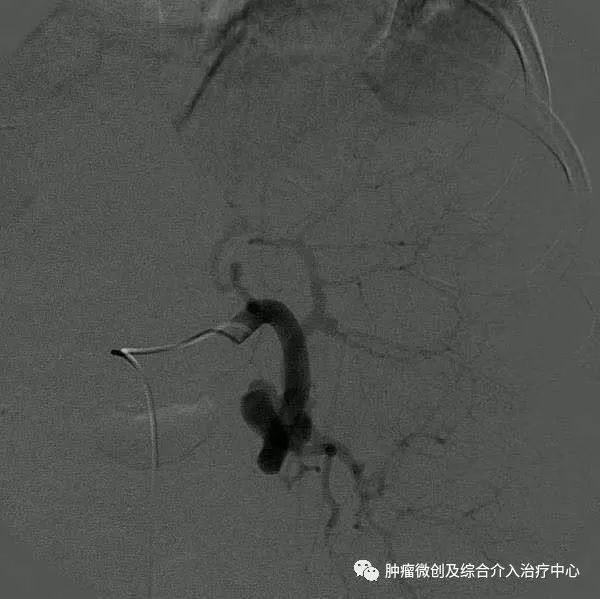 脾动脉栓塞术,脾栓塞手术的适应症