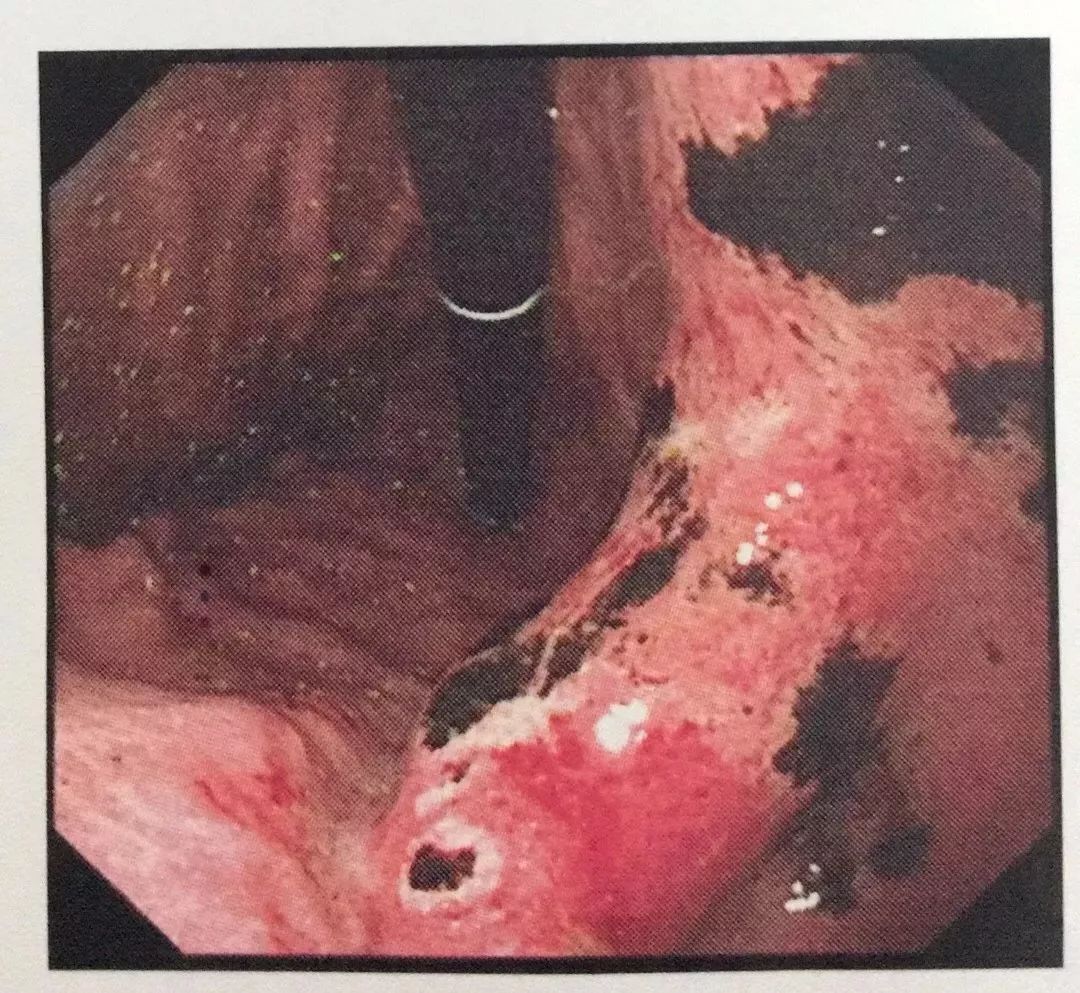 吃一次等于喝3次马桶水!这个食物让小伙整个胃烂了…