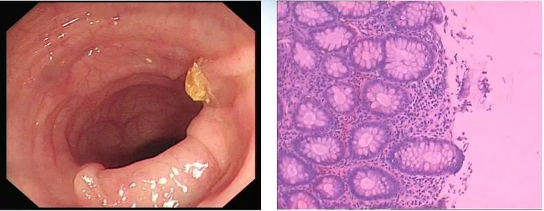 粪菌移植治疗溃疡性结肠炎,粪菌移植治疗溃疡性结肠炎费用