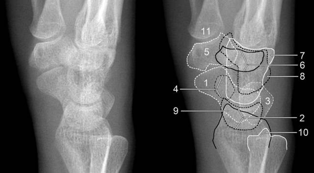 青少年尺腕关节脱位x线诊断标准,腕关节侧位x线片读片技巧