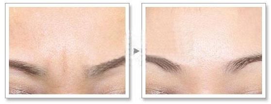 外用涂抹式肉毒素可以祛皱纹吗,去皱纹的肉毒素一年打几次为佳