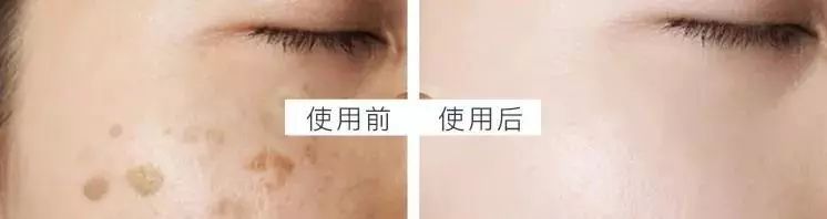 严重痘印晒斑,5个祛斑小妙招淡化晒斑雀斑痘印