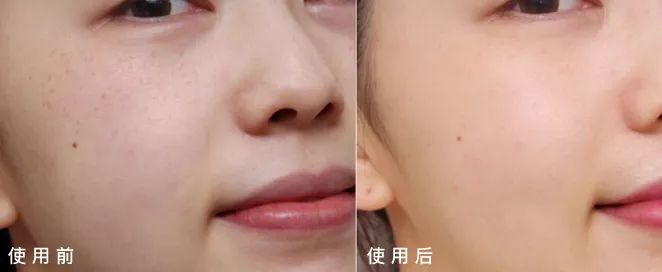 晒斑痘印去除土方法,5个祛斑小妙招淡化晒斑雀斑痘印