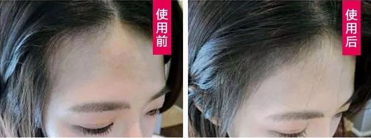 发际线防脱发神器,增发神器发际线