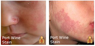 宝宝身上有这六种胎记,宝宝身上这8种胎记需要密切关注