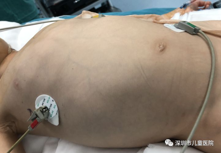 4岁娃肚大如孕妇，体内抽出2斤寄生虫液！铲屎官们注意，这虫能让你“狗带”