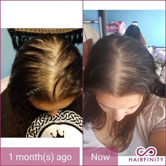 发际线防脱发神器,增发神器发际线