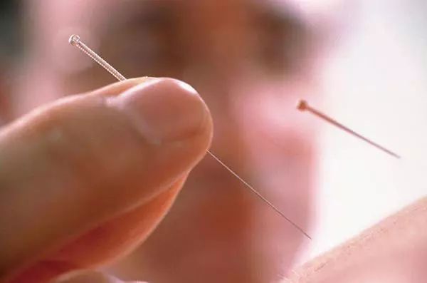针灸可以用于麻醉,你知道吗?——写在针刺麻醉发展60余年