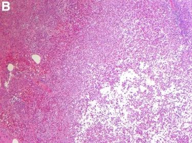 结肠镜检查疼吗,做完电子结肠镜后有腹痛