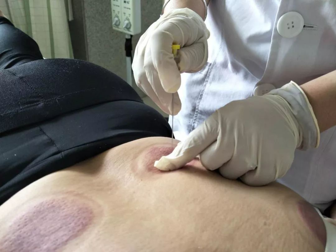 带状疱疹中医辨证及方剂,中医治疗带状疱疹的方剂