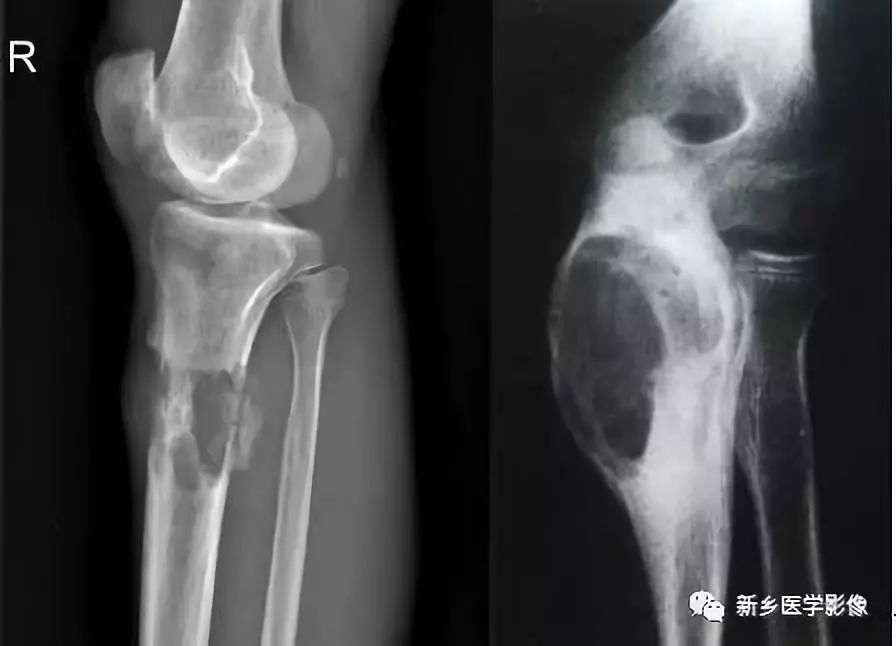 骨骼疾病怎么调理最有效,骨骼坏死最佳治疗方法