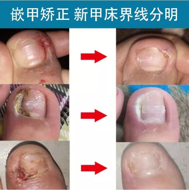 趾甲扎进肉里了，一碰就痛？用它一贴，1分钟止痛，趾甲往外长，再也不扎痛了！