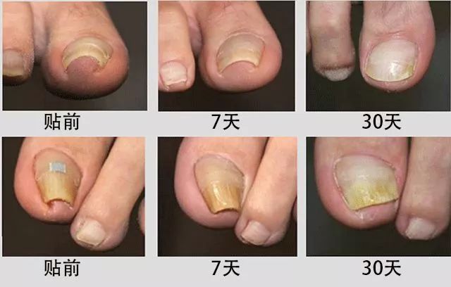 趾甲扎进肉里了，一碰就痛？用它一贴，1分钟止痛，趾甲往外长，再也不扎痛了！