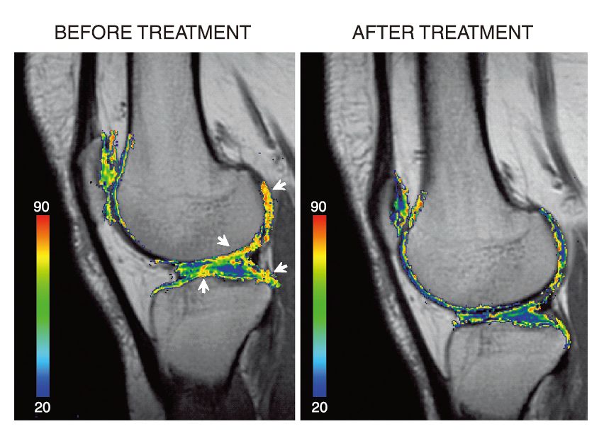 膝关节软骨退化干细胞治疗,间充质干细胞治疗膝关节