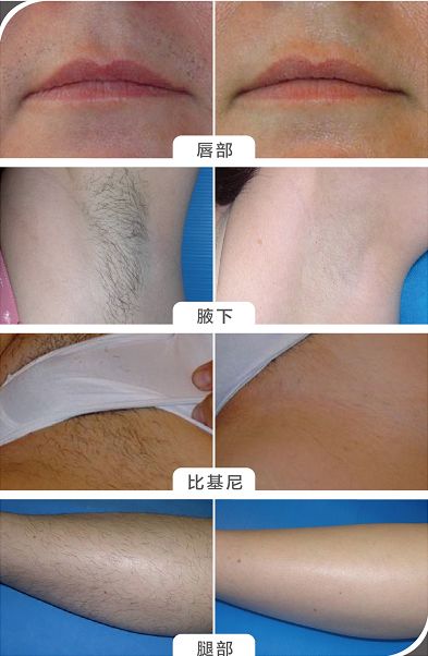 【杏林微科普】脱毛疗程知多少？