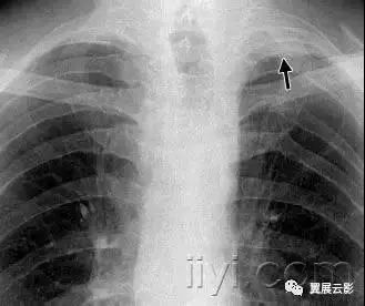 胸部解剖及常见疾病影像表现,胸部影像学基础知识