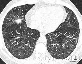 胸部解剖及常见疾病影像表现,胸部影像学基础知识