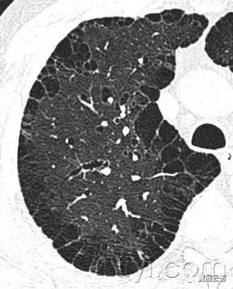 胸部解剖及常见疾病影像表现,胸部影像学基础知识