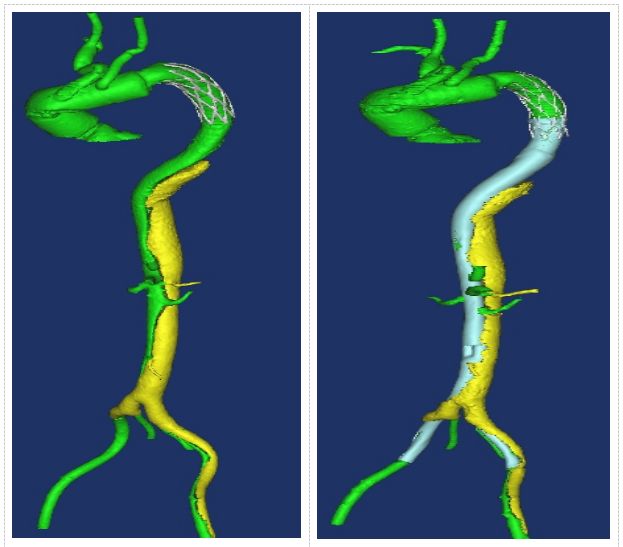 华西主动脉夹层手术怎样,再次救治急性主动脉夹层取得成功