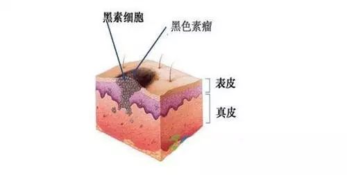 注意身上有这种黑痣要立刻就医,黑痣注意事项