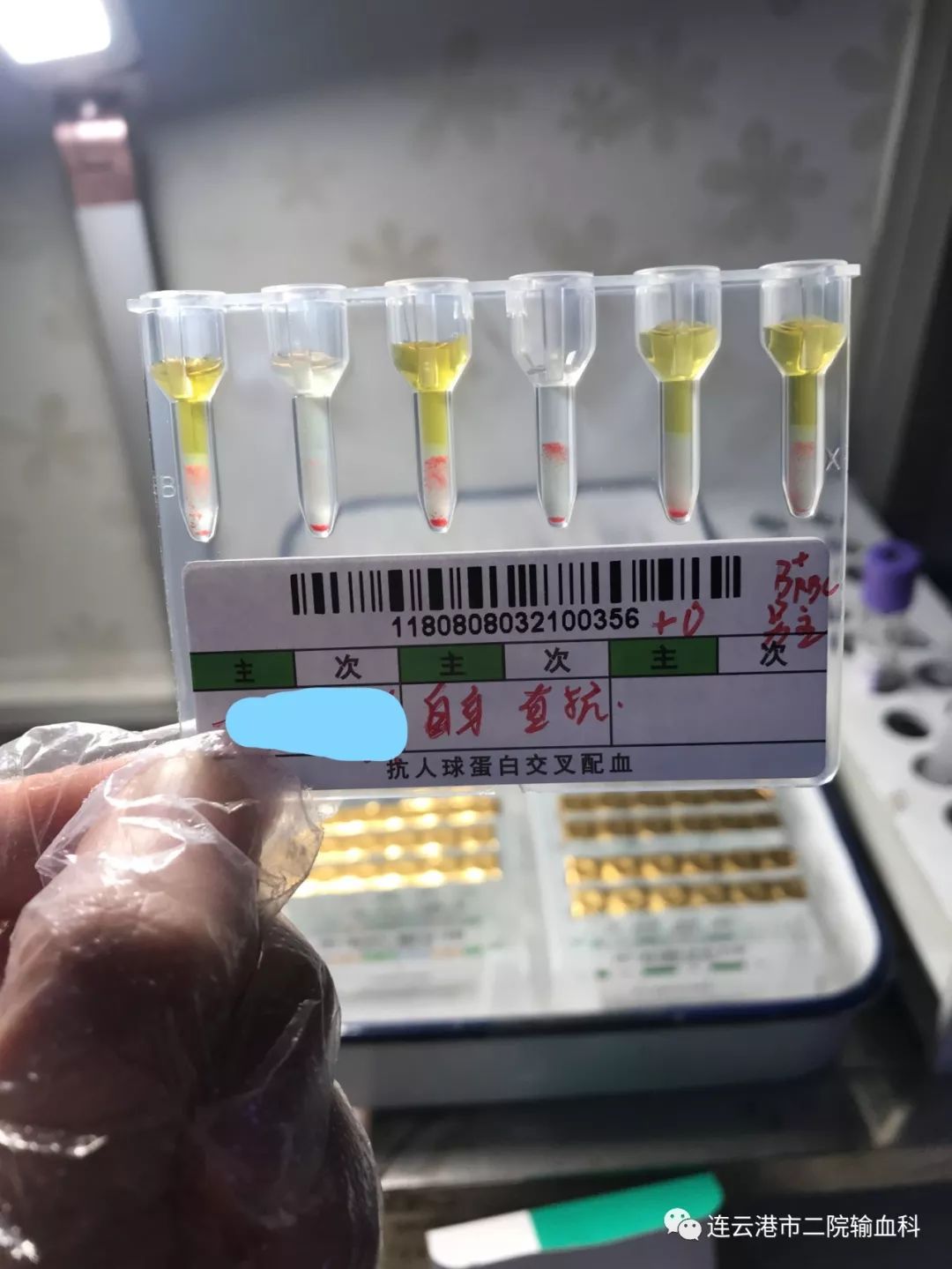 吓坏了的婴儿,b型血和o型血的宝宝会溶血吗