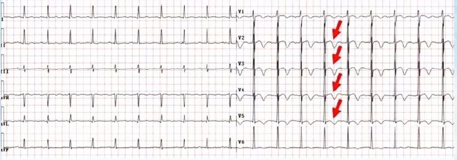 胸痛心电图表现,胸痛的心电图鉴别诊断