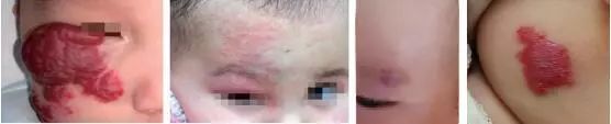 孩子脸上红色胎记什么原因引起,孩子脸上红棕色的胎记