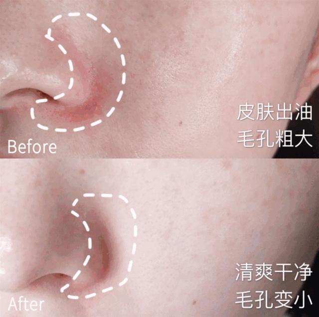 为什么能从鼻头上挤出白色的东西,鼻子挤出来的白丝是什么