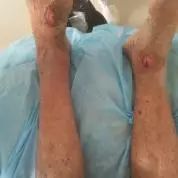 疮很常见，天疱疮你了解吗？