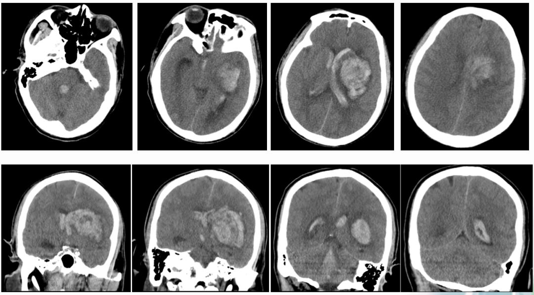 径技·例量|25期：再灌注出血—防不胜防
