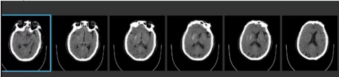 径技·例量|25期：再灌注出血—防不胜防