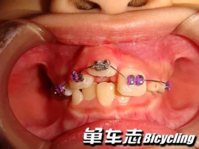 骑车摔伤牙齿松动怎么办,骑车磕到牙齿怎么办