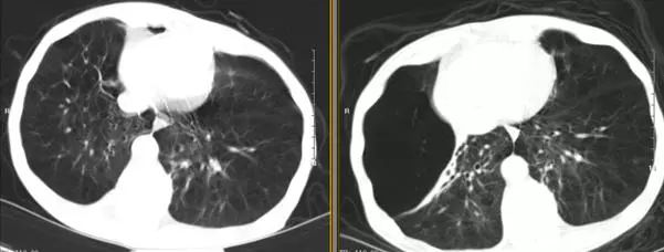 支气管镜热消融术治疗慢阻肺,西京医院支气管镜