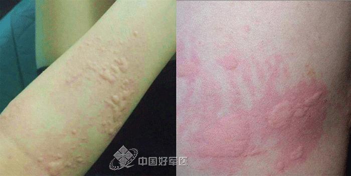 野外驻训，这6招帮你轻松搞定*麻疹荨**！