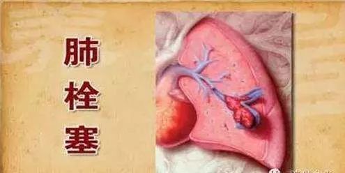 老人熬夜打麻将却造成悲剧,老人打麻将下肢静脉血栓