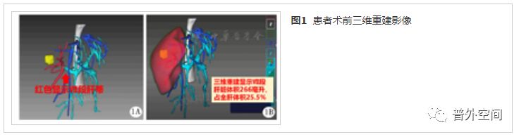 吲哚菁绿荧光引导腹腔镜解剖性肝脏Ⅶ段切除手术流程