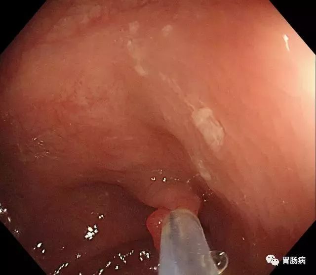 结肠息肉切除术术前准备,结肠镜下息肉冷切除术