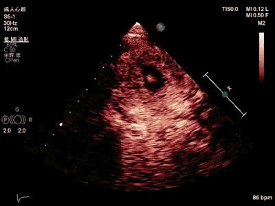 亚急性心内膜炎有蛋白尿吗,loeffler心内膜炎发病概率