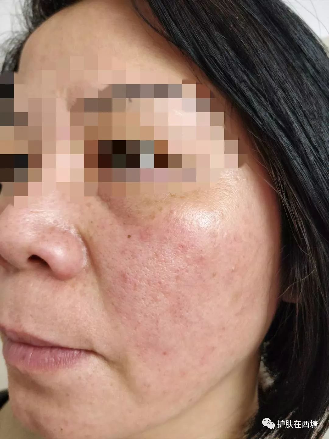 面部皮肤病科普,皮肤科普激素依赖性皮炎