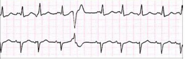 急性心梗后能恢复正常吗,急性心梗缓解后还需要支架吗