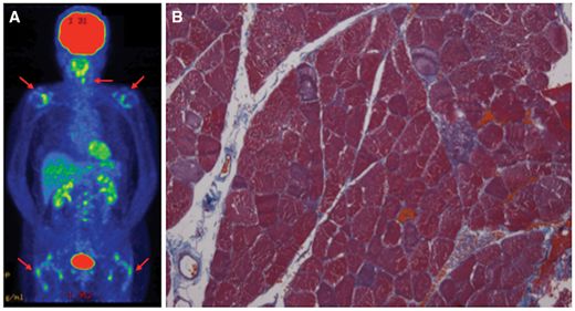 多发性肌炎最新诊断,多发性肌炎和皮肌炎哪个更重