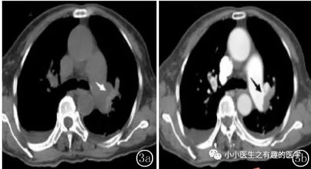 ct平扫肺部能查出是哮喘吗,ct平扫肺结节准确吗
