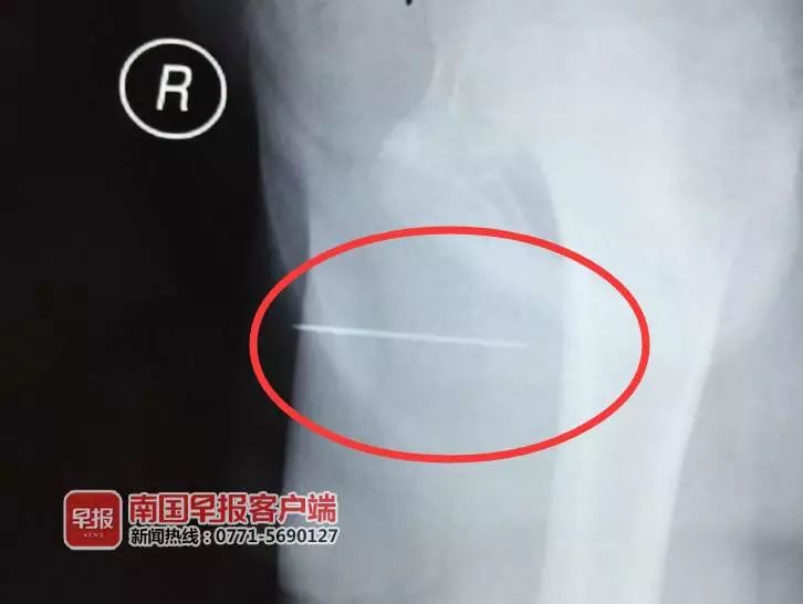 看着就很痛！广西一男孩竟将4.5厘米长缝衣针塞入*体下**…