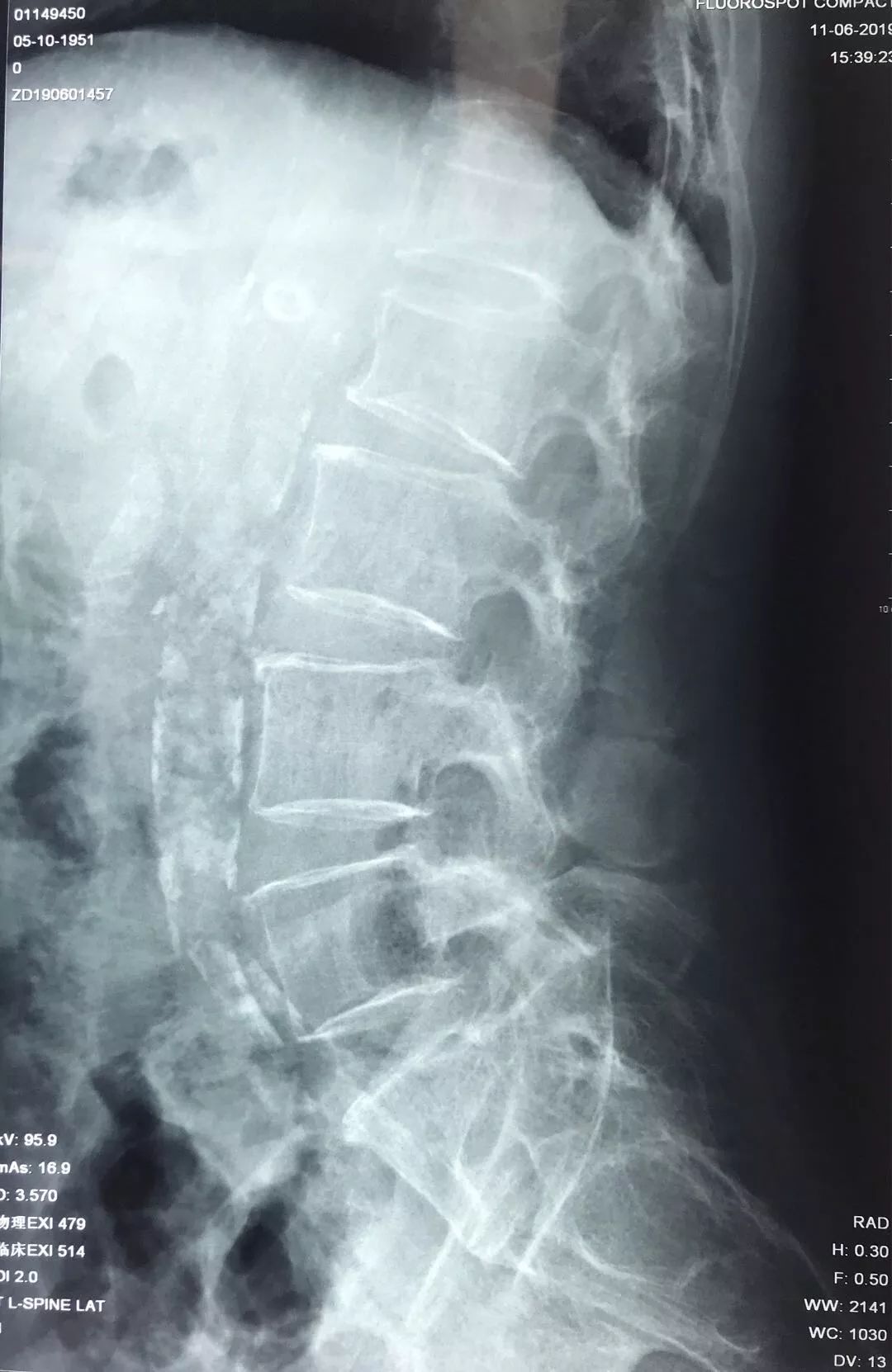 骨科科普压缩性骨折,陈旧性压缩骨折和新近压缩骨折