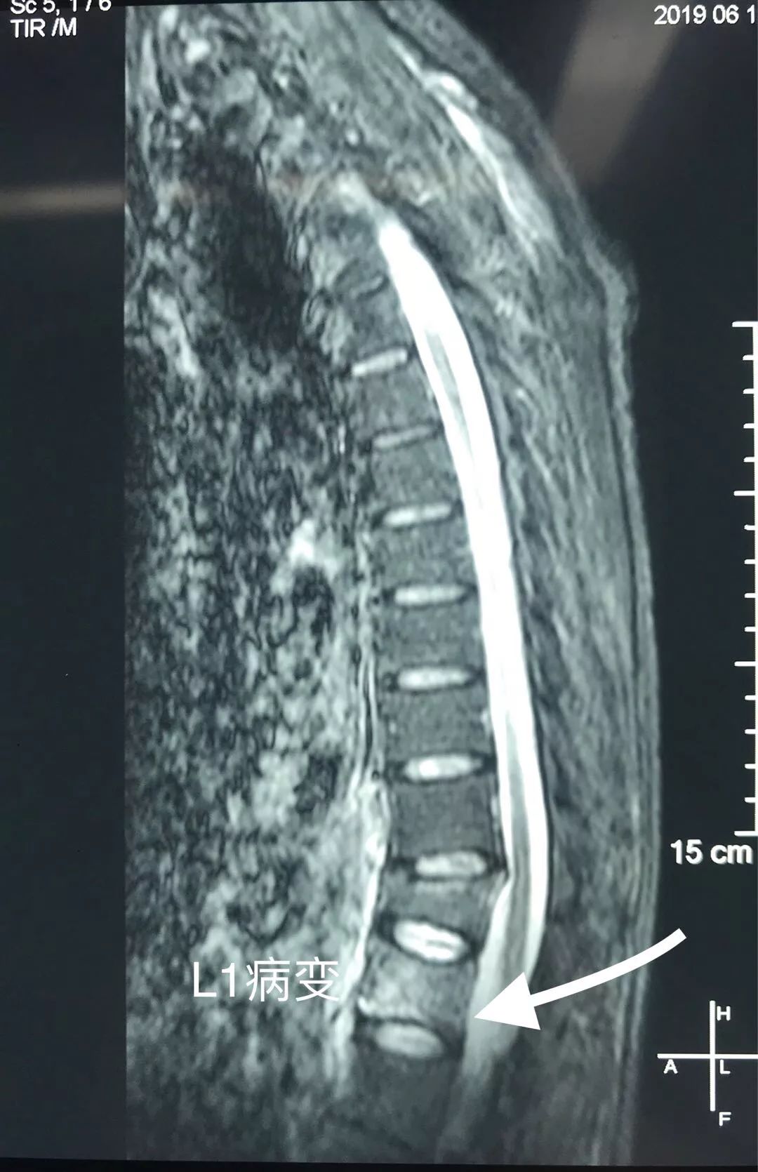 骨科科普压缩性骨折,陈旧性压缩骨折和新近压缩骨折