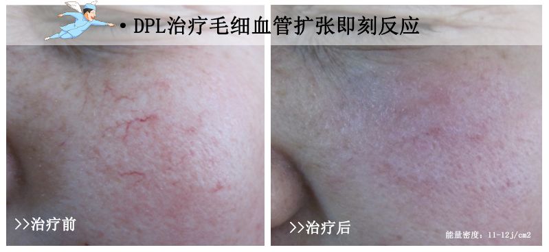 脸上的红血丝怎么处理,脸上的红血丝怎么解决