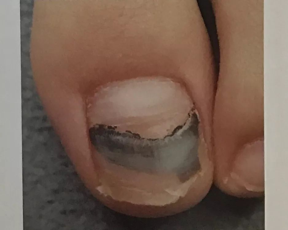 怎么治疗灰趾甲才能彻底不反复,如何快速自然地摆脱指甲真菌