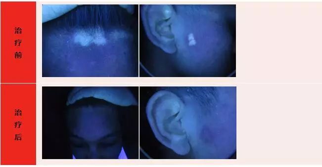 “夏”一个康复就是你！南昌国丹特邀北京白癜风专家公益巡诊，机不可失